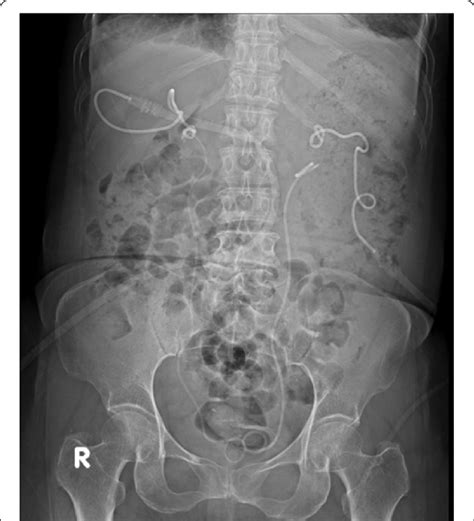 Bilateral Percutaneous Nephrostomy Catheters And Antegradely Inserted