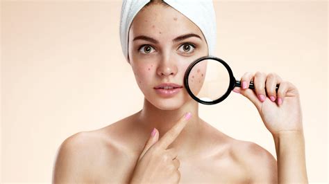 Causes Of Acne How You Can Face Mapping To Understand Breakouts Healthshots