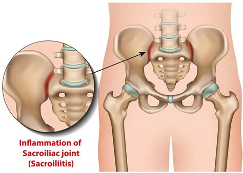 Sacroiliac Joint SI Fusion Dr Todd Jackman Stillwater Spine Surgeon