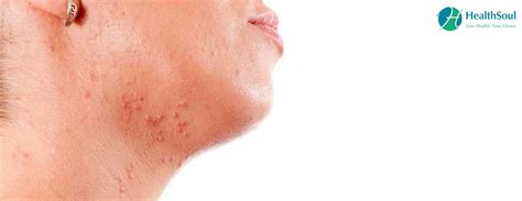 Molluscum Contagiosum Symptoms And Treatment Dermatology Skin