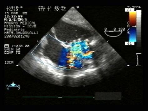 Stuck Mitral Bio Prosthetic Valve