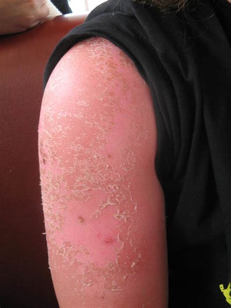 Sunburned And Peeling Arm — Science Learning Hub