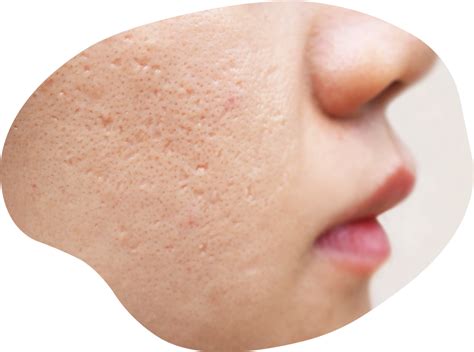 Acne And Acne Scars Treatment Halley Medical Aesthetics
