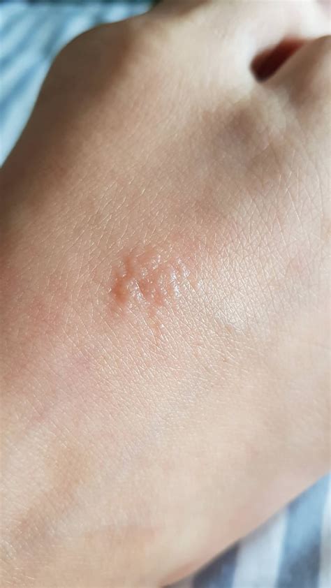 Itchy Rash On Top Of Foot