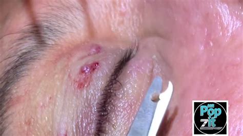 Eyelid Milia Blackheads And Tags Delicate Eyelid Extractions