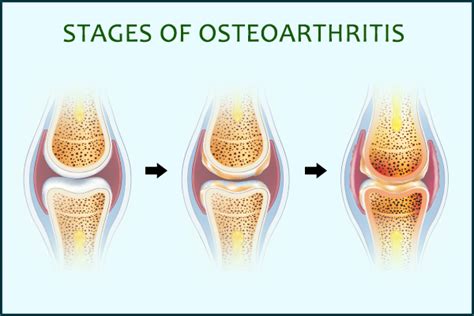 Osteoarthritis Stages Symptoms And Treatments In Mansfield Tx