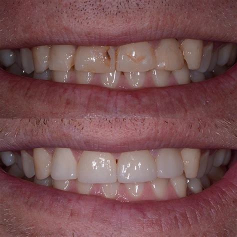 Happy Patient Large Fillings On The Front 4 Teeth That Involved Most Of The Surfaces Recurrent