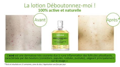 Lotion Naturelle Anti Acné Boutons Peaux Mixtes Ou Grasses Indemne