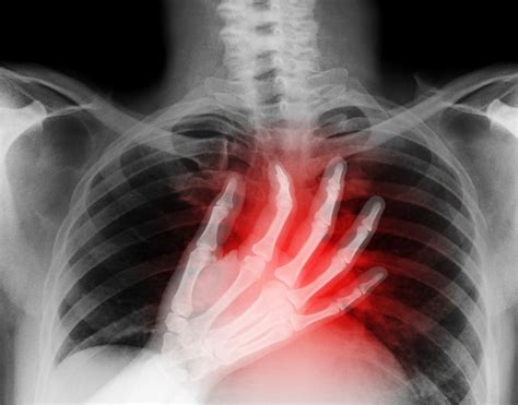 I share this, not to scare you, but because i believe knowledge is power. Costochondritis - Causes, Symptoms, and Treatment