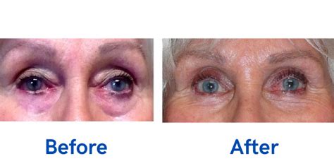 Oculoplastic Surgery Before And After Gallery Eye Surgery Associates