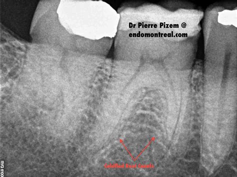 Calcified Tooth Pain Teeth Bonding