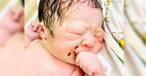 La Sorprendente Historia Del Bebé Que Nació Con El Diu De Su Madre