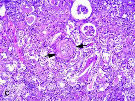 Issues related to acute kidney injury, glomerular disease, and hypertension, uptodate how is acute respiratory distress syndrome (ards) managed in patients with critical coronavirus disease. American Urological Association - Malignant Hypertension