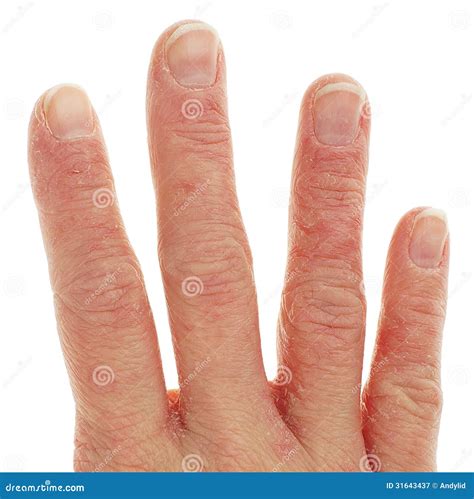 Closeup Of Eczema Dermatitis On Fingers Stock Image Image Of Health