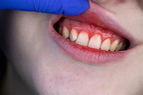 Entz Ndung Am Zahnfleisch Symptome Ursachen Behandlung