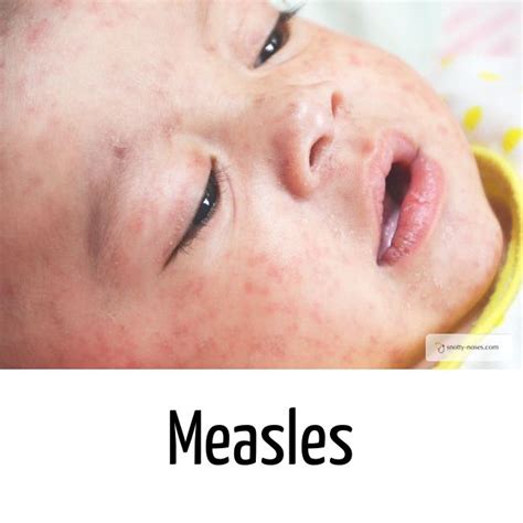 Measles In Children Snotty Noses