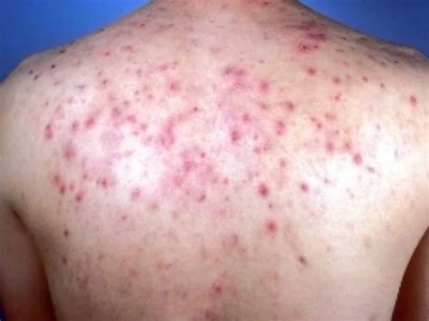 Back Acne Causes And Best Treatment To Get Rid Of Back Acne And Scars