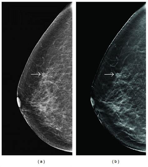 How Does Breast Cancer Look Like On A Mammogram Learn About Fighting