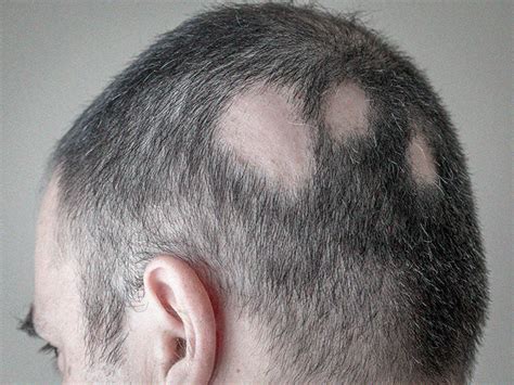 Scalp Conditions Examples Treatment And Pictures