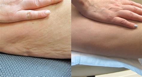 Smagliastop per eliminare smagliature funziona? Cellulite Treatment Before and After | Photos | Woodbridge ...
