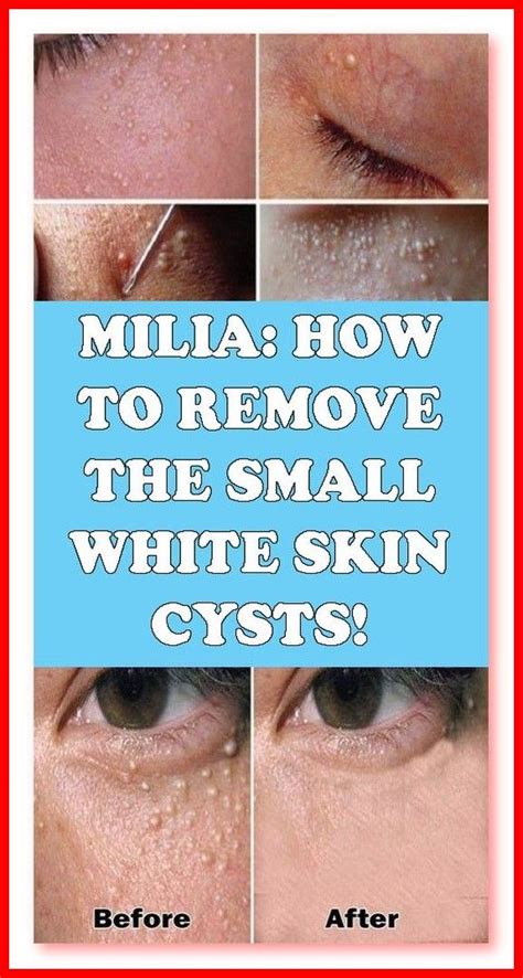 MILIA HOW TO REMOVE THE SMALL WHITE SKIN CYSTS In Skin Cyst Whiter Skin Cysts