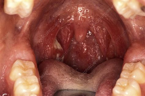 Ulcerated Tonsils Throat Examination Stock Image M2700340