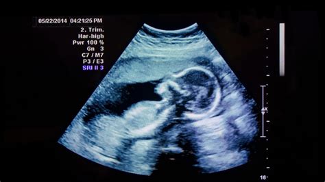How To Read An Ultrasound Guidelines For Understanding The Ultrasound