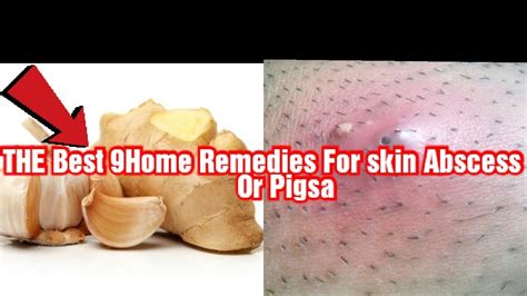 The Best 9home Remedies For Skin Abscess Or Pigsa Youtube