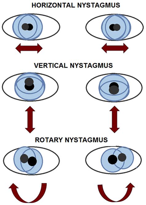 Eye Nystagmus Causes Types Signs Symptoms Test Nystagmus Treatment