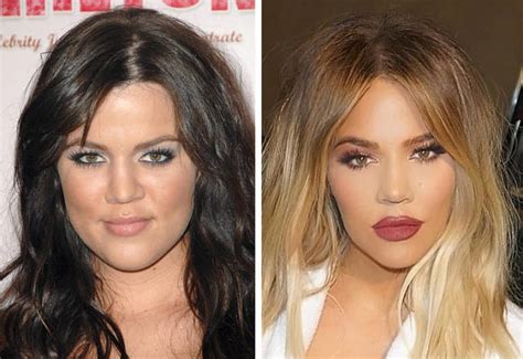 Celebrity Plastic Surgery Before After Pics Picture Celebrities