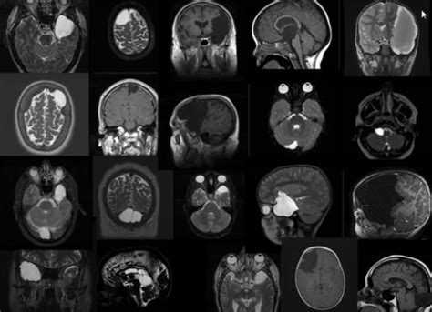 Incidental Findings Common On Paediatric Brain Mri Scans