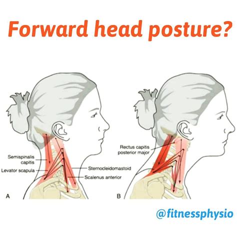 Forward Head Posture Forward Head Posture Is Often Related To A