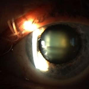 In latin, cataracta had the alternative meaning portcullis79 and the name possibly passed through french to form the english meaning eye disease (early 15th century), on the notion of obstruction. Cataracta corticalis • Praxis Zeitz Franko Zeitz