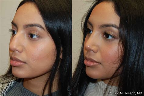 Eric M Joseph Md Rhinoplasty Before After Hump Removal And Tip Rotation