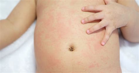 Rashes In Children What Causes Them Netmums