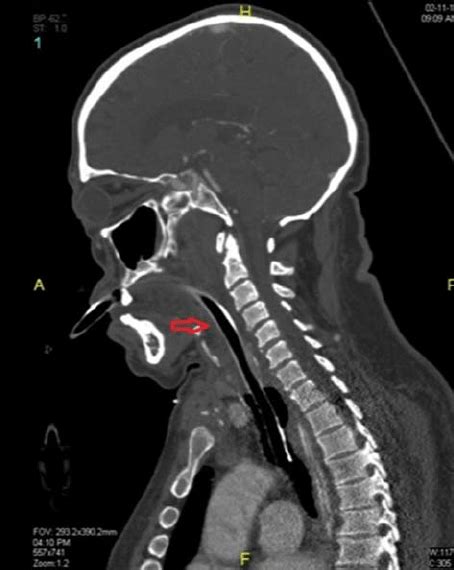 Sagittal Plane Of A Soft Tissue Neck Ct Scan 48 Hours After Onset