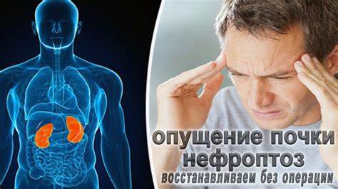 Опущение почки, Нефроптоз восстанавливаем без операции - YouTube Картинка - Опущение почки, Нефроптоз восстанавливаем без операции - YouTube
