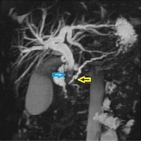 Magnetic Resonance Cholangiopancreatography Mrcp Shows Hepatobiliary