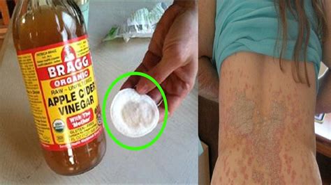 Pin On Fungal Infection Skin