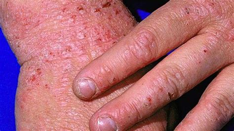 Types Of Eczema Identification Pictures And More