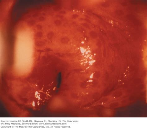 Colposcopy—normal And Noncancerous Findings Basicmedical Key