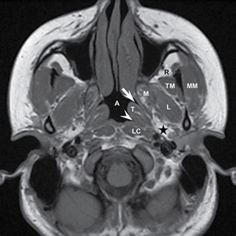 Mucosal Cancers Neck Primaries And The Lymph Nodes Radiology Key