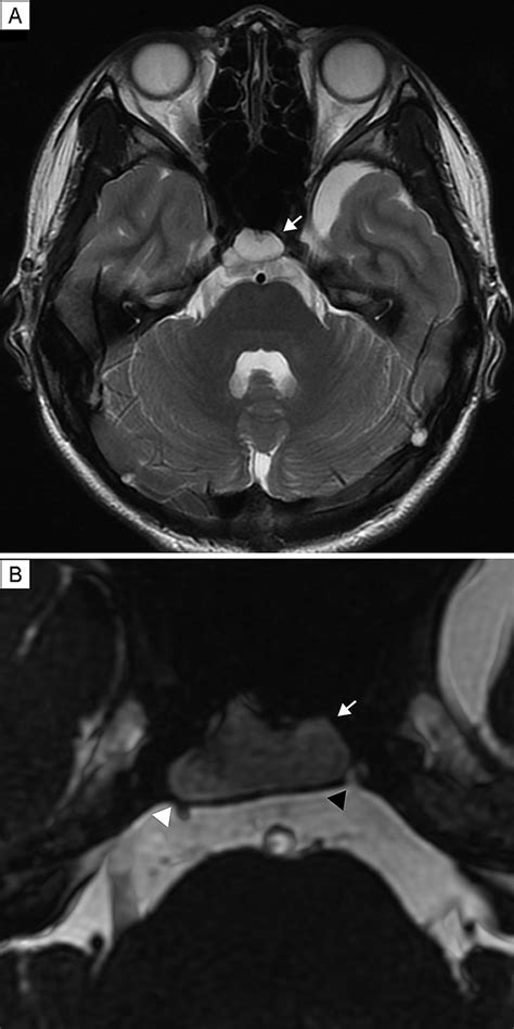 Ecchordosis Physaliphora Presenting With Abducens Nerve Palsy Journal