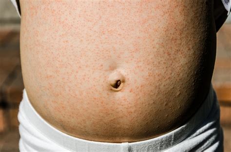 Close On A Childs Belly To Show Rashes All Over Stock Photo Download