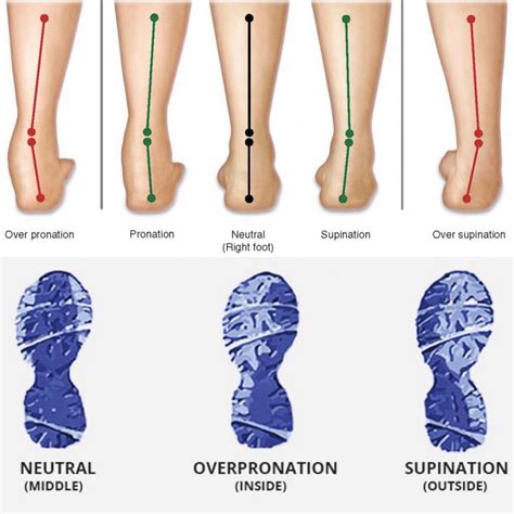 Helping Overpronation Why Shoe Stability Is The Key Hot Sex Picture