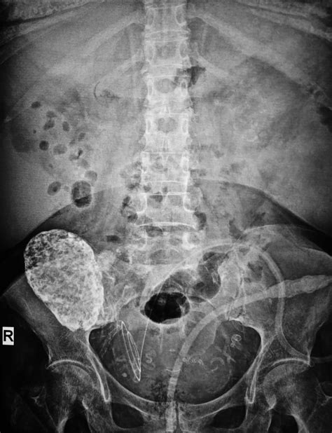 Plain Abdominal Radiography Shows Diffuse Calcification Of The Renal