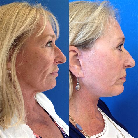 Lower Face Lift 1 Barbarino Surgical Arts