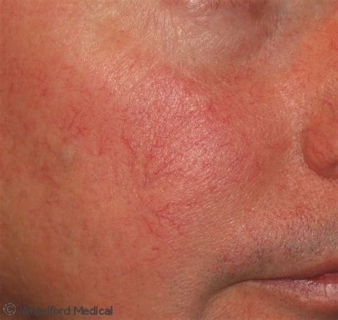 Facial Redness Rosacea And Blushing Woodford Medical