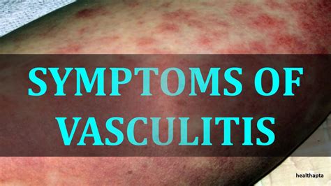Symptoms Of Vasculitis Youtube