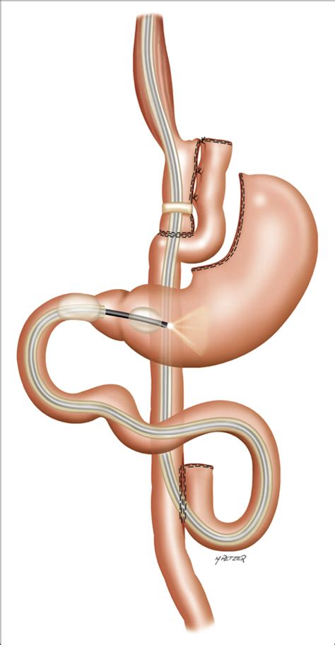 Endoscopic Findings In The Excluded Stomach After Roux En Y Gastric Bypass Surgery Bariatric